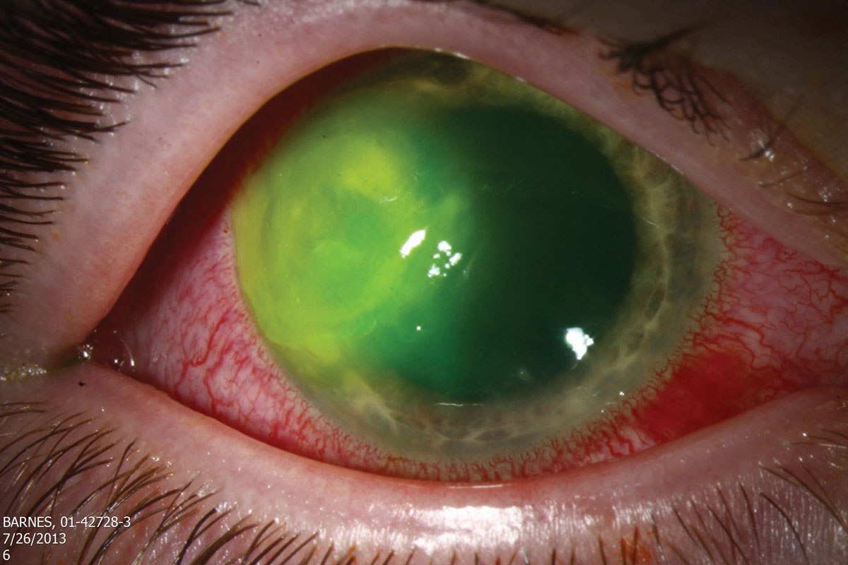 This patient has Pseudomonas keratitis. Given the higher risk of stromal damage in gram-negative bacterial infections, your treatment regmen should be appropriately aggressive.