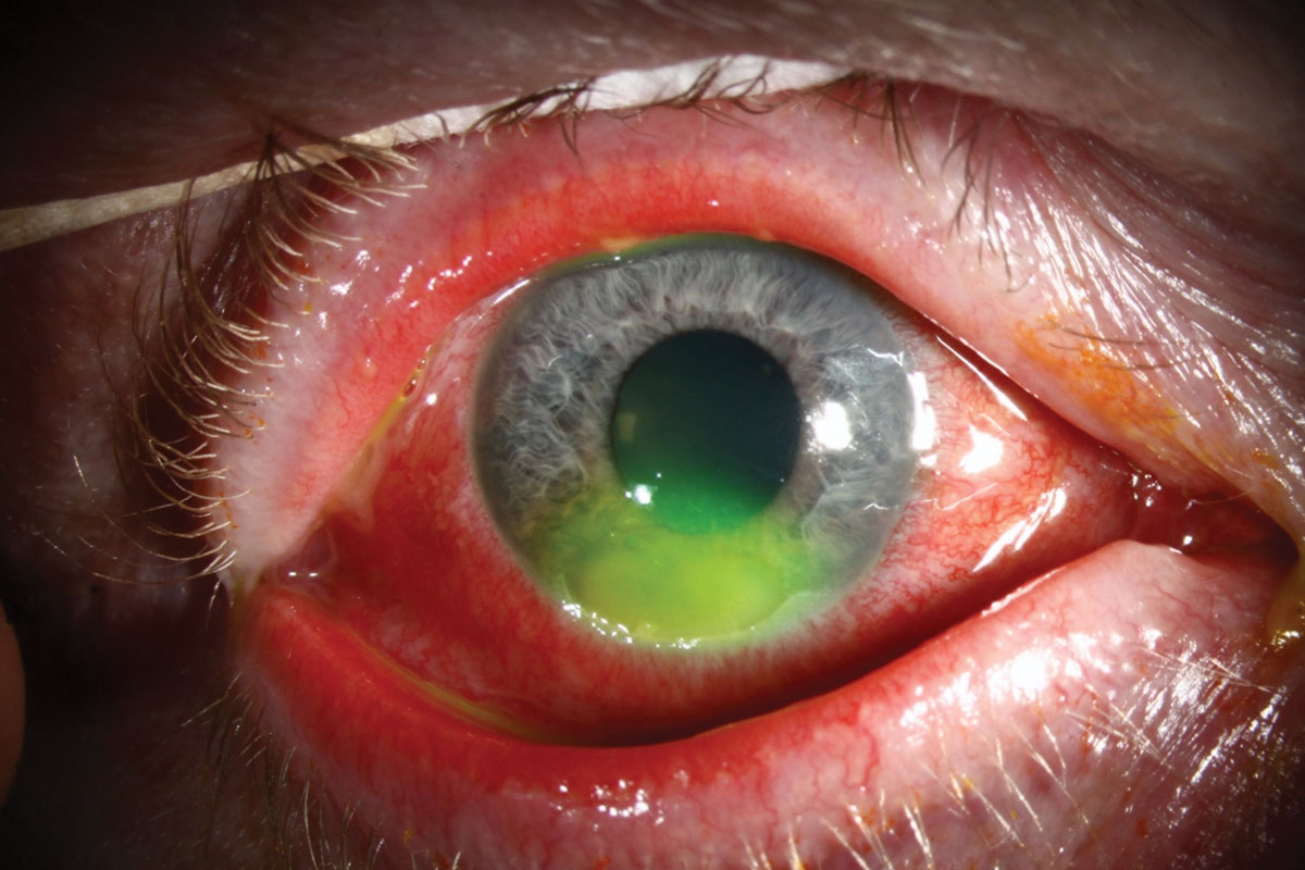 This patient has microbial keratitis after abrasion from a cockle burr. Any exposure to vegetative material raises the risk of polymicrobial infection.