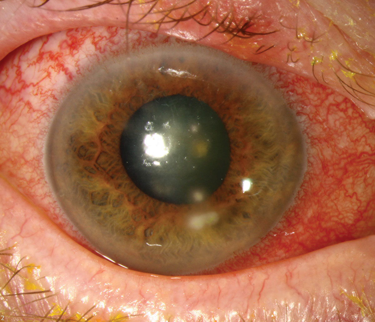 This patient has HSV keratitis with stromal infiltrates.