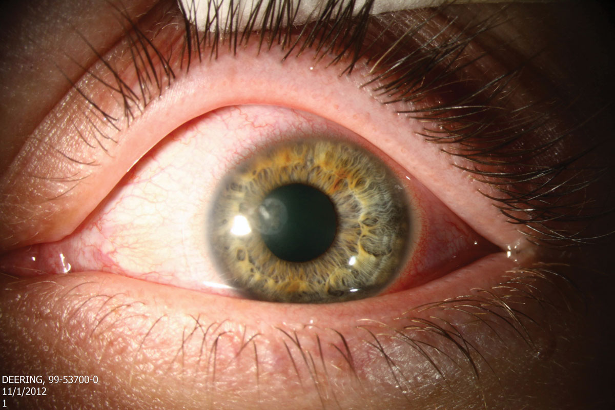 Natamycin, the mainstay treatment for fungal keratitis, is not readily available at most retail pharmacies. Instead, seek out a pharmacy at a local medical center.