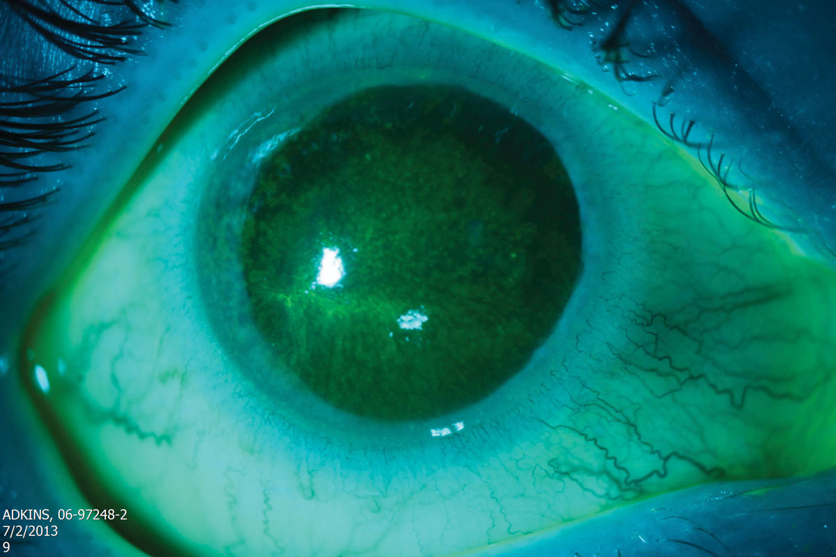 If diagnosis of Acanthamoeba keratitis is delayed, the amoeba will have already penetrated further into the corneal stroma, which causes therapy to be more difficult.
