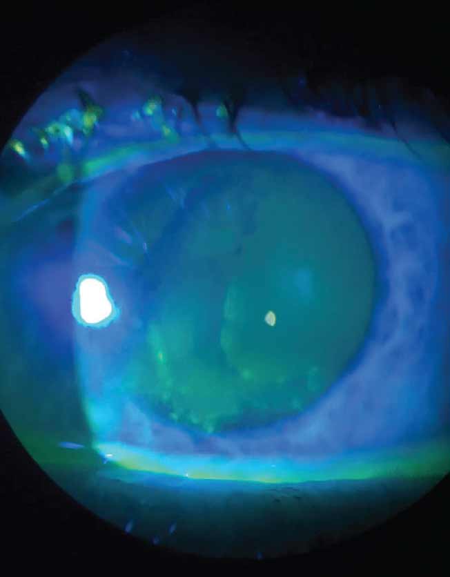 Fig. 1. Slit lamp view of fluorescein staining in a patient with anterior basement membrane dystrophy.