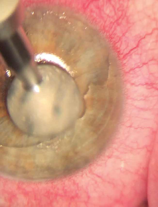 Fig. 3. Slit lamp view of a debridement of the corneal epithelium under topical anesthesia using a foreign body spud. This procedure is effective for treating active acute RCE.