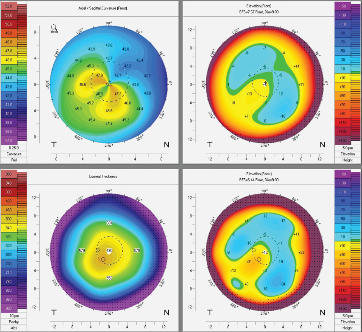 Topographies of an early keratoconus patient post-CXL. Crosslinking binds collagen fibers to adjacent ones using riboflavin drops and UV light. While some Kmax flattening occurs, patients should be told that CXL is done to reduce progression, not improve vision.