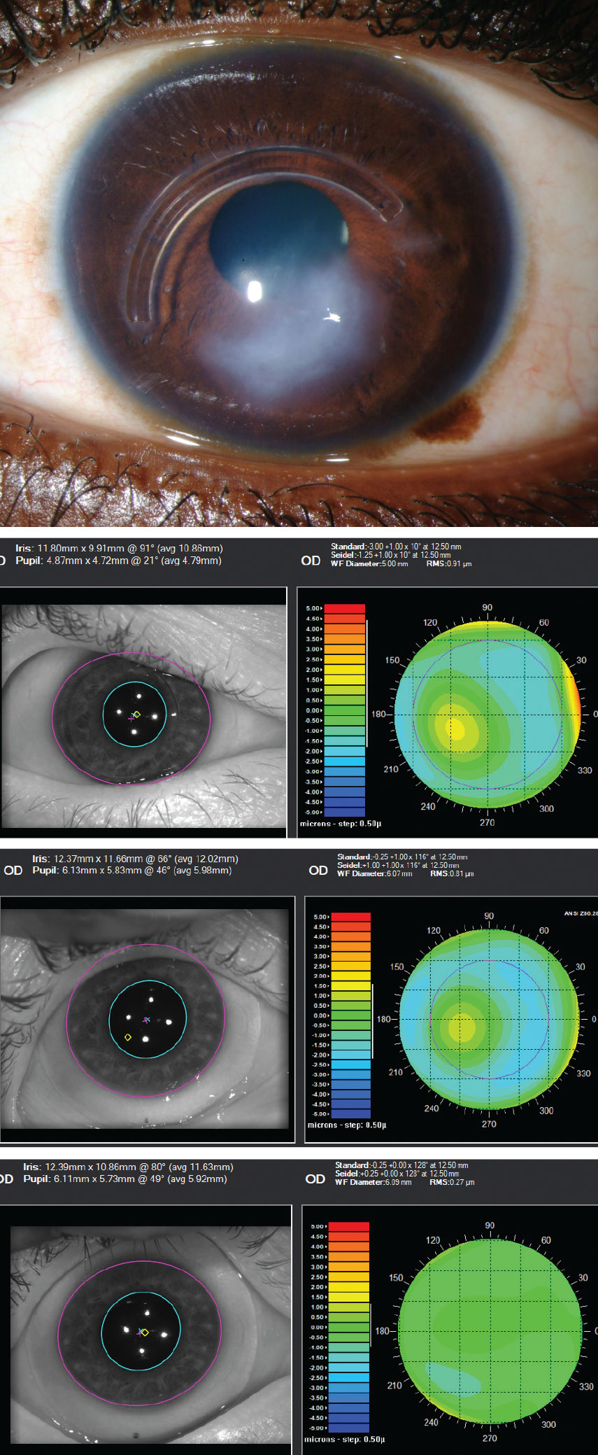 This series shows an advanced keratoconus patient with Intacs ring implantation and significant scarring. First image: slit lamp appearance. Second image: the impact of higher-order aberrations without correction (0.91µm@5mm pupil). Third image: aberrations remain with scleral lens wear (0.81µm@6mm pupil). Fourth image: aberration profile has been improved with use of an HOA-corrected scleral lens (0.27µm@6.09mm pupil).