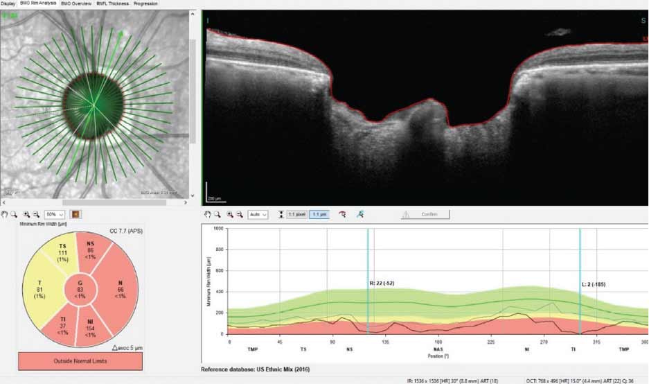 A significant loss of neuroretinal rim tissue inferotemporally, with loss of 185µm shown in the selected radial scan.