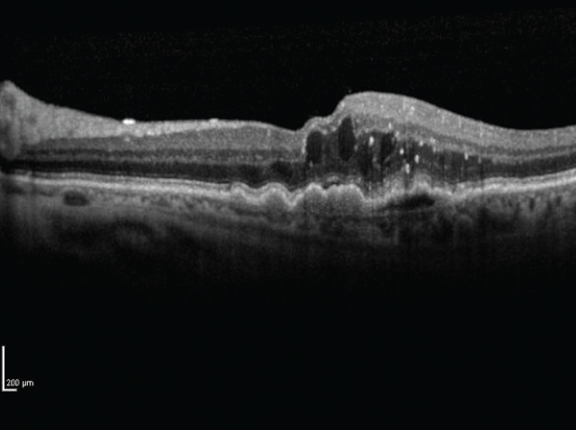 Retinal OCT findings were associated with reading acuity score and maximal reading speed in a study on nAMD patients previously treated for exudation.