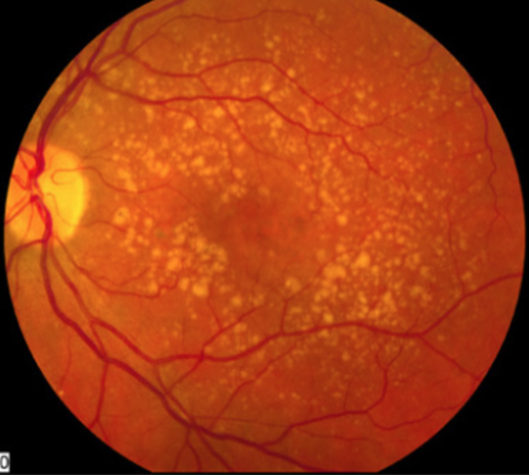Autoantibodies against inflammatory proteins were downregulated in patients with AMD.