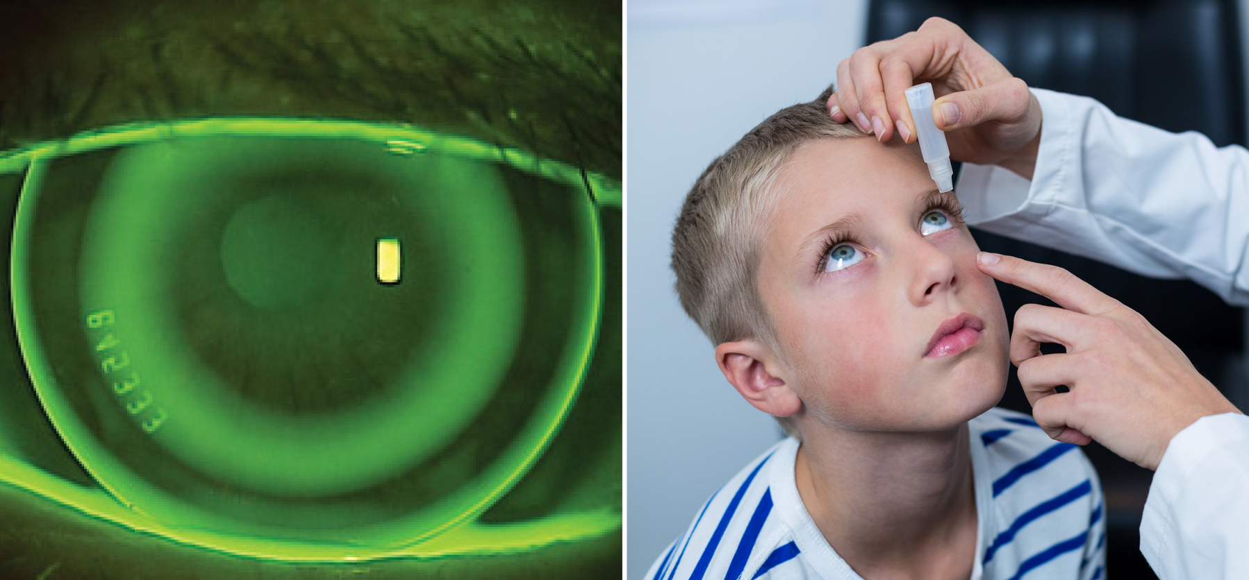 Ortho-K and atropine are effective in preventing and controlling myopia.