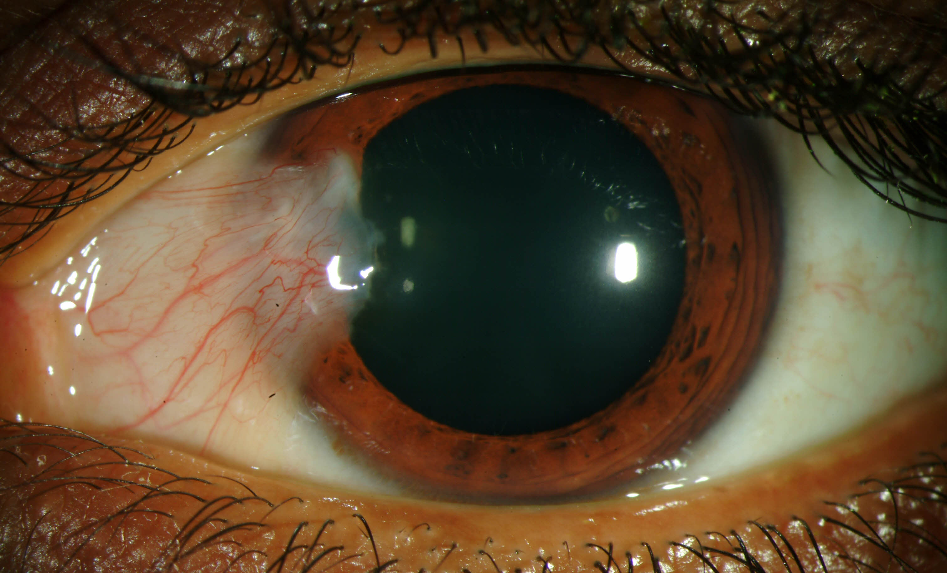 Pterygium length, width and area were found to predict optical changes, while thickness may serve as a clinical indicator of eventual recurrence.