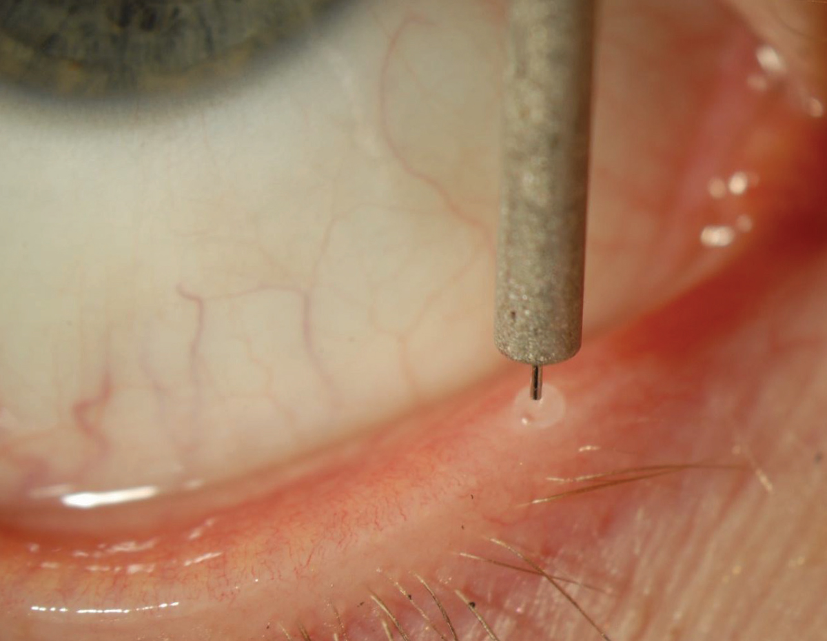 Though intracanalicular inserts occlude the punctum, they weren’t found to increase ocular allergy symptoms. Researchers suggest that increased tear conservation may dilute allergens.