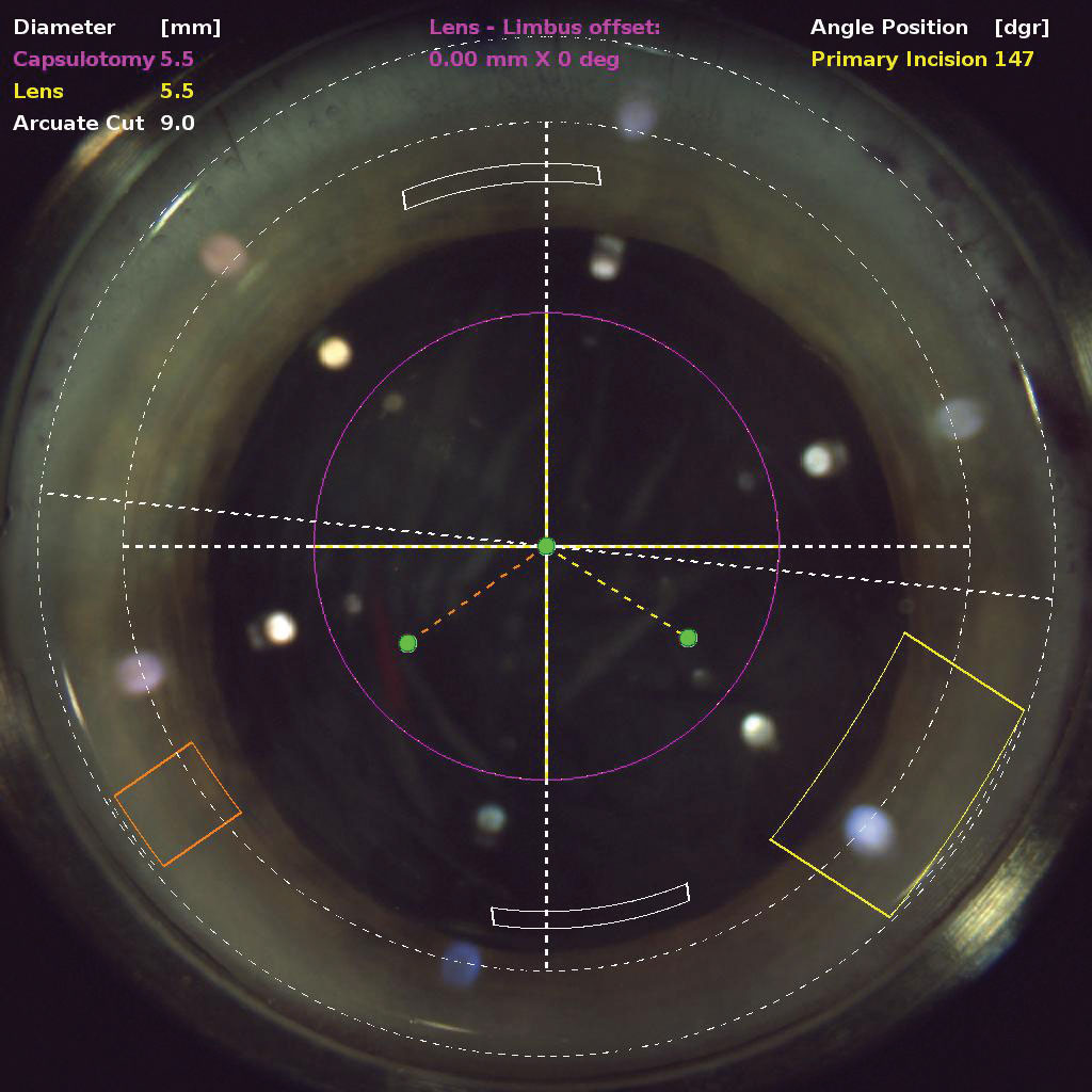 A robust health economics analysis in France found that femtosecond laser-assisted cataract surgery in its current state of development was not cost-effective.