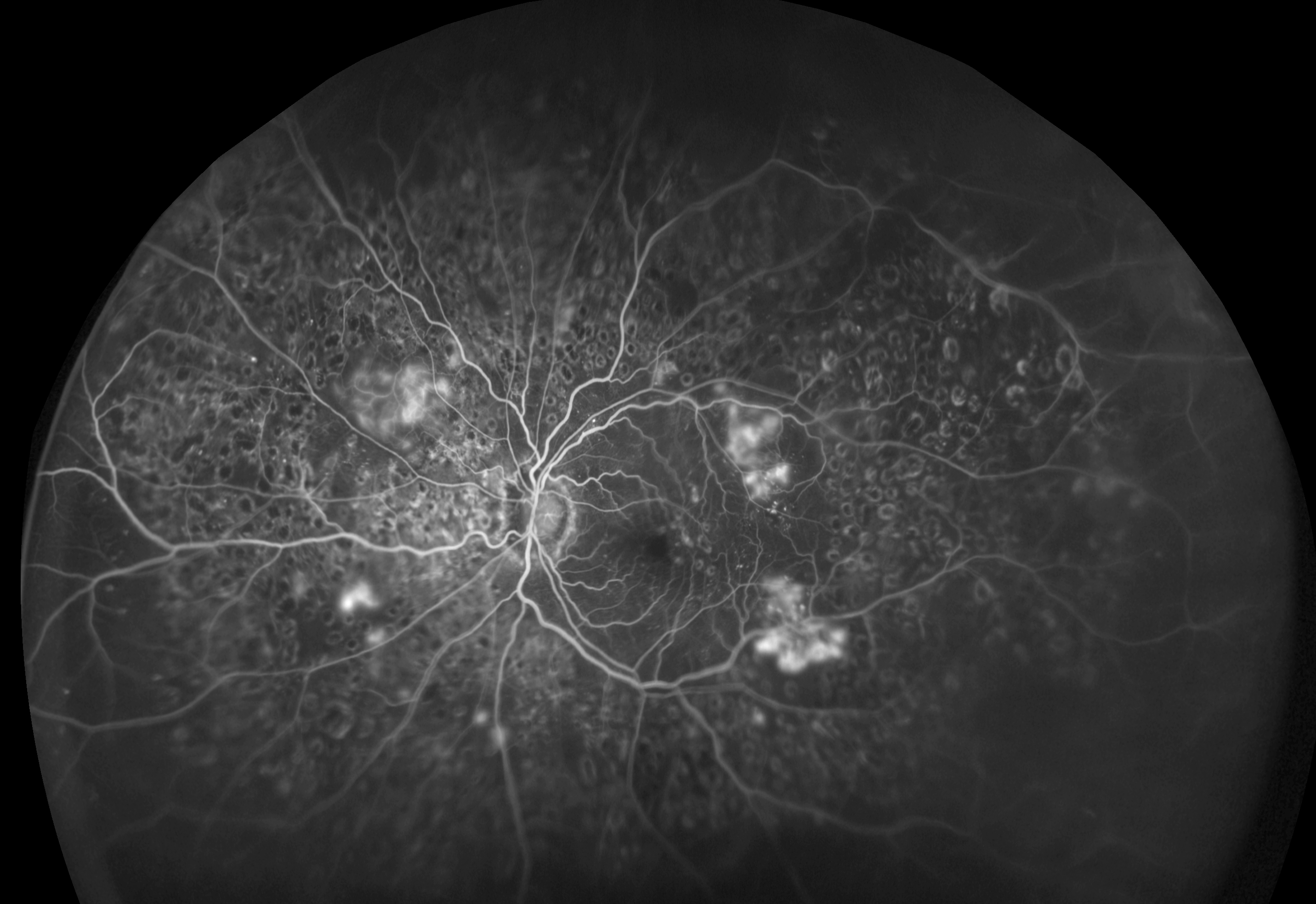 Severe proliferative diabetic retinopathy may go undetected in patients with severe mental illness, as these patients often don’t see an eye doctor until it’s too late.