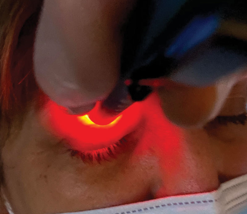 Inadequate lid seal as detected by the Korb-Blackie light test. Common in OSA patients, this exposes the ocular surface during sleep and leads to tear film evaporation.