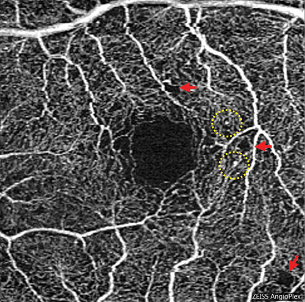 Basic AI algorithms may be used to advance prognosis of early diabetic retinopathy. 