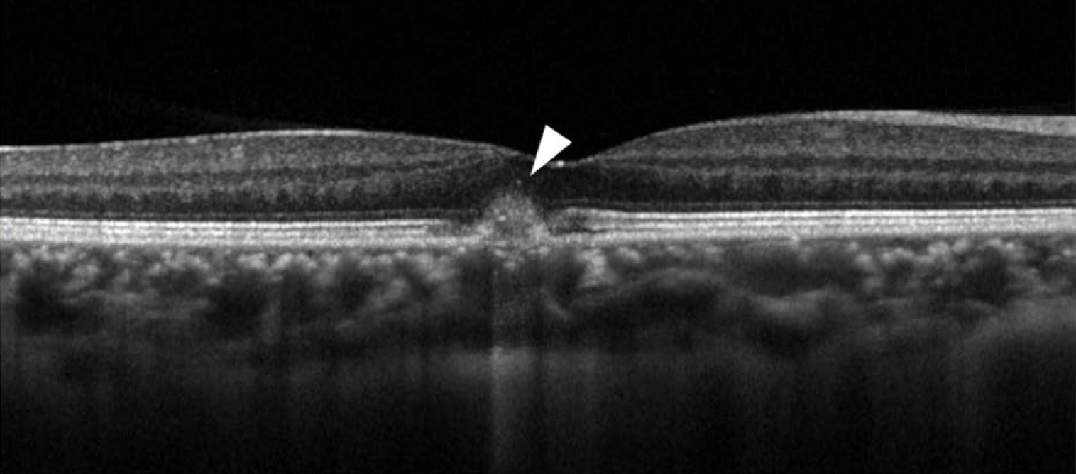 While macular neovascularization is a common source of chorioretinal thickening, clinicians should be aware that some cases of non-neovascular pachychoroid disorder also present with hyperreflective signal on OCT. This SD-OCT of a 36-year-old woman with visual complaints in her right eye revealed a CCT of 305μm with pachyvessels. Elevation of RPE with HRM at the subretina was also observed.