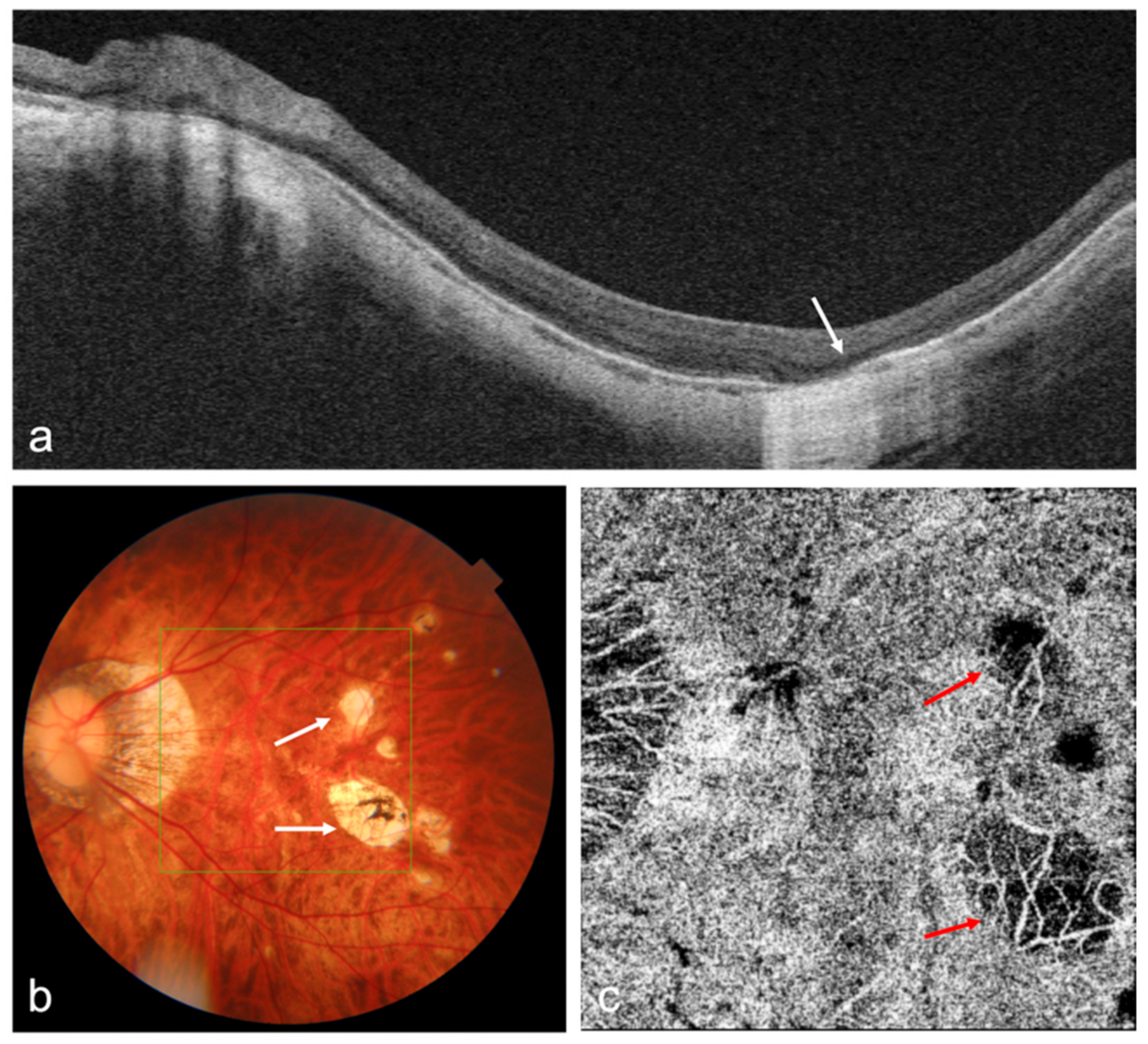 OCT and OCTA images of a highly myopic eye with patchy chorioretinal atrophy. (a) Swept-source OCT (SS-OCT) B-scan image shows the loss of retinal pigment epithelium (RPE), Bruch’s membrane, and choroid corresponding to the patchy atrophy area (white arrow); (b) Fundus photography shows patchy chorioretinal atrophy (white arrows); (c) OCTA image shows the loss of choriocapillaris flow signals corresponding to the patchy atrophy area (red arrows).