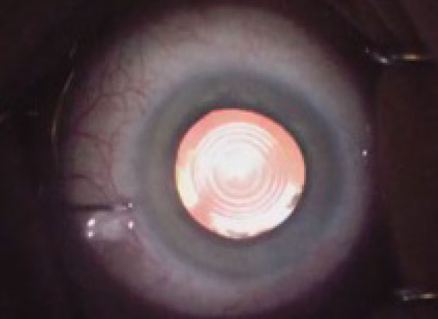Intraoperative aspects can also influence IOL performance, such as size and centration of the capsulorhexis.