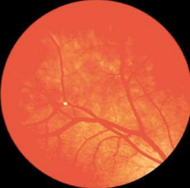 More timely testing for glaucoma, either by visual field testing or with retinal nerve fiber layer imaging, can be the difference in preserving sight in individuals with a history of RVO. 