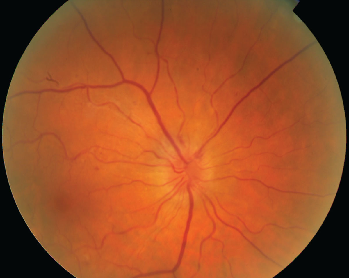 Hypertensive retinopathy causing constriction of retinal arterioles in response to elevated systemic blood pressure and autoregulation.