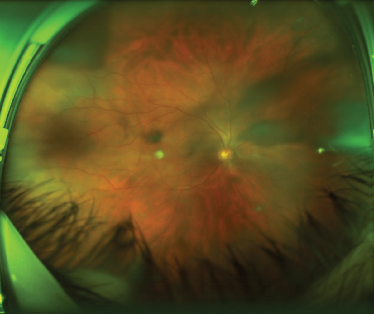 Fig.1. Optos photo of the right eye, with two cortical spokes nasally and a wide one superior temporal.