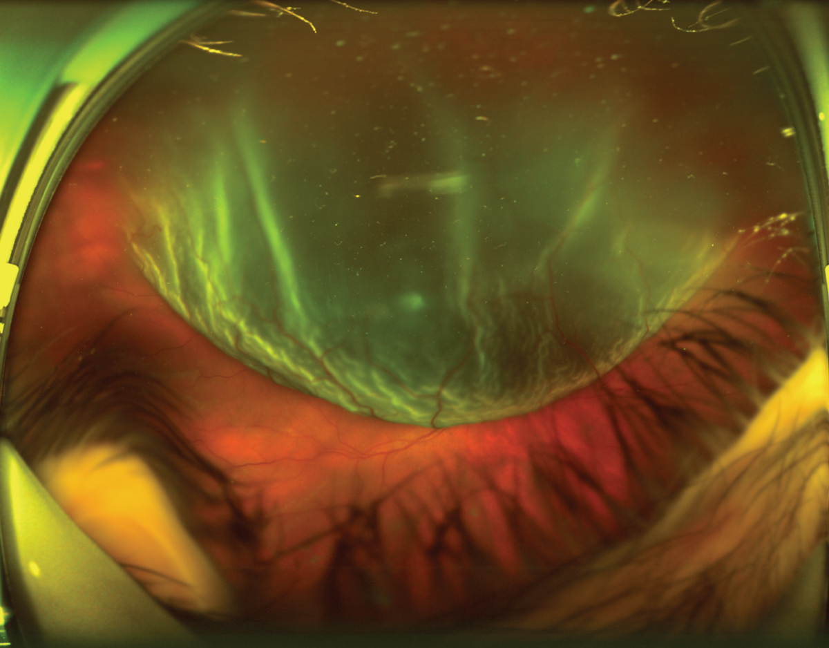 Fig. 2. The retinal specialist described a superior-temporal macula-off retinal detachment.