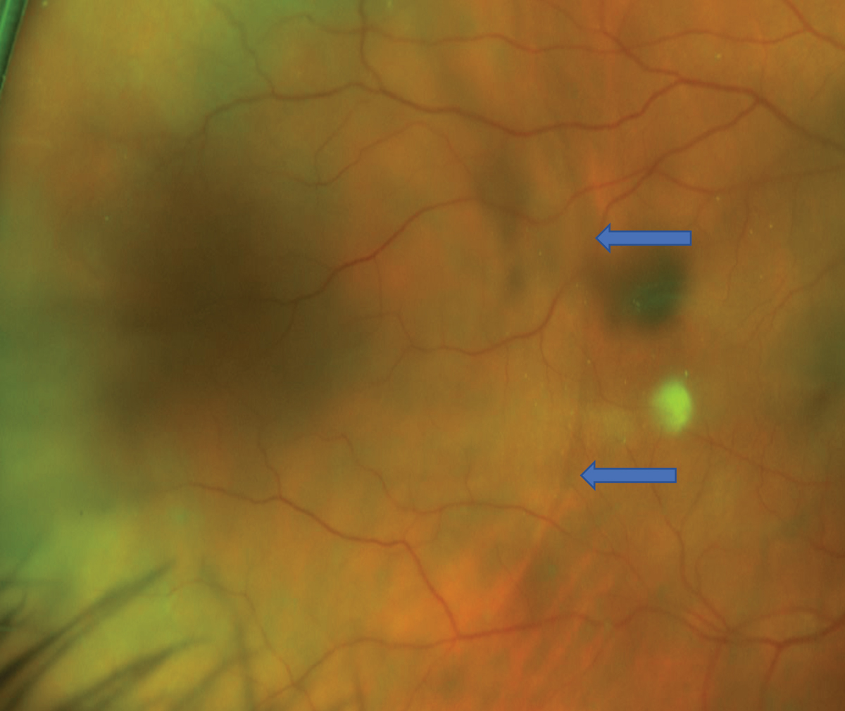 Fig. 3. Magnified view of the temporal retina OD one month prior to large retinal detachment. It reveals a circular border, possibly denoting a shallow retinal detachment (blue arrows). 