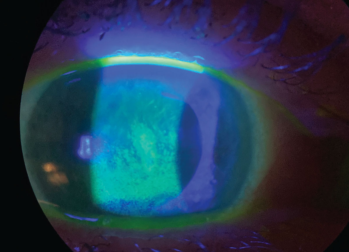 An example of dry eye compromising  the ocular surface, seen with sodium fluorescein staining. Dr. Craig believes upon the release of the full reports, education on topics like dry eye will be reciprocally exchanged by clinicians and their patients, leading to increased awareness.