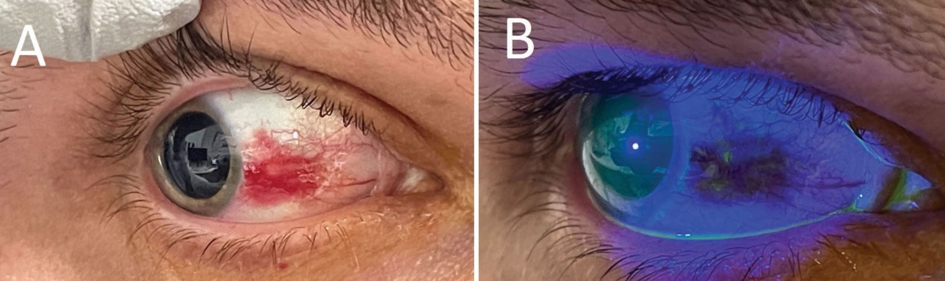 (A) Right eye under white light, revealing a focal subconjunctival hemorrhage in an otherwise quiet-appearing eye. (B) After sodium fluorescein application, there was a tiny conjunctival defect appreciable in the area of hemorrhage.