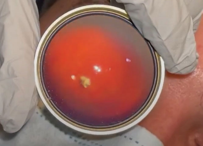 An intraocular metallic shard was seen on binocular indirect ophthalmoscopy OD.