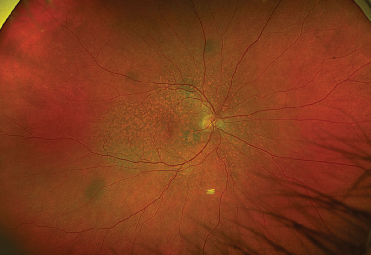 Fig. 1. Optos ultrawide fundus photograph of the right eye.