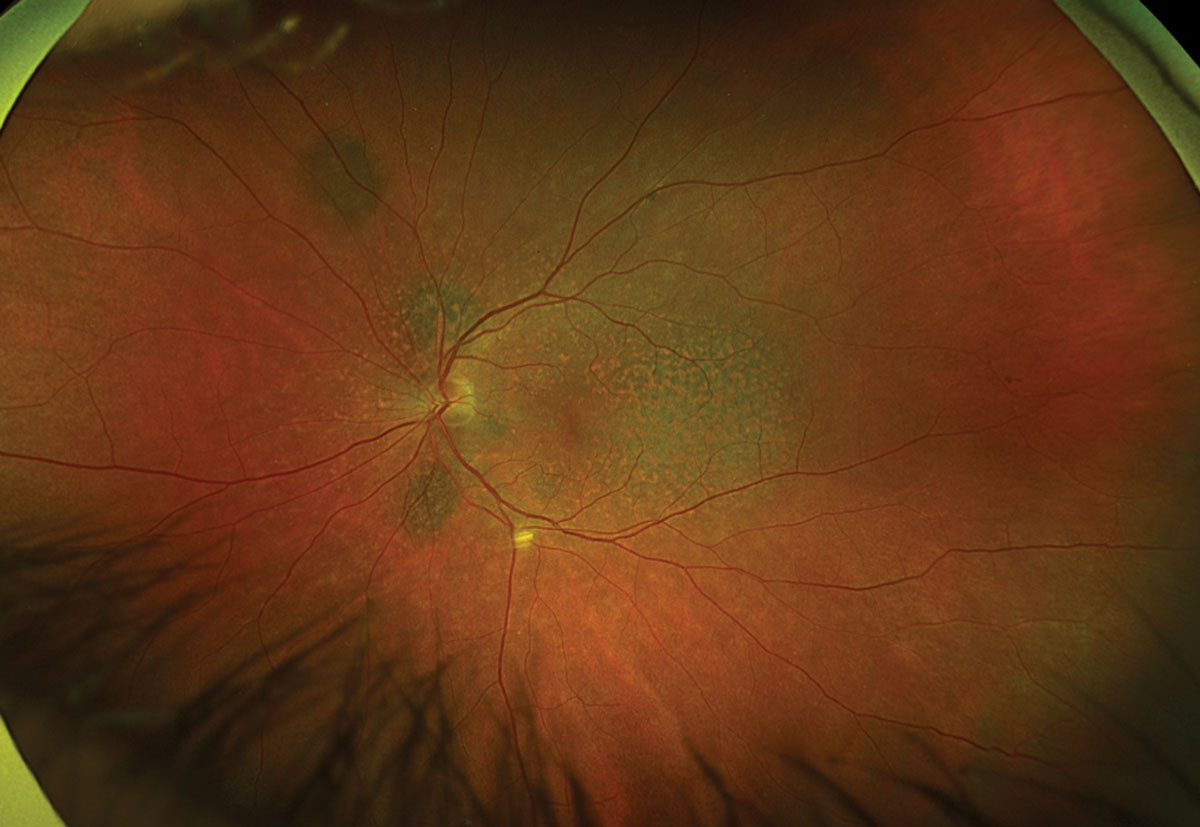 Fig. 2. Optos ultrawide fundus photograph of the left eye.
