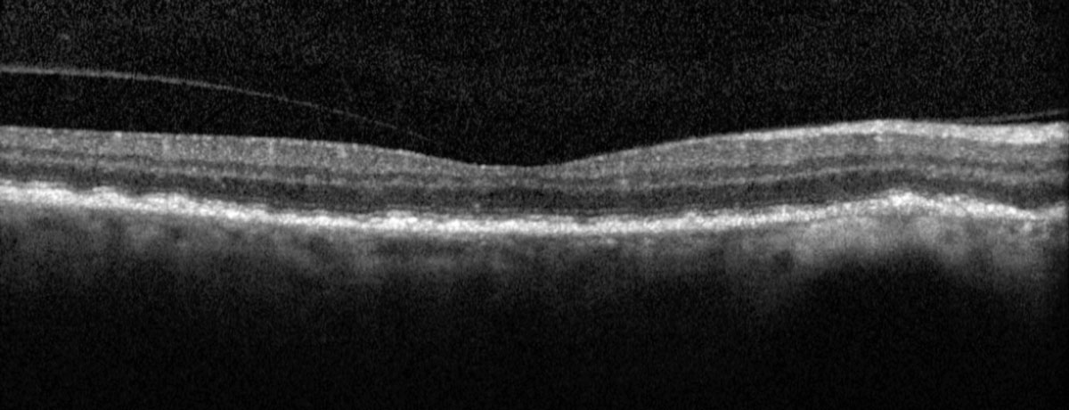 Fig. 5. Heidelberg macular OCT of the right eye.