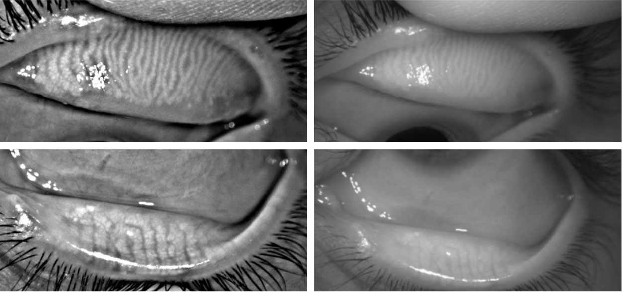 Meibography images from the Oculus keratograph showing normal meibomian gland number and morphology within the upper and lower lids.