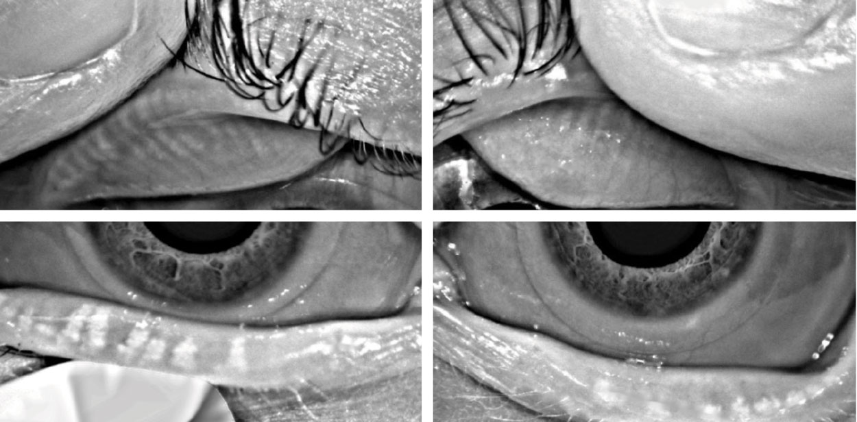 Meibography images from a long-term contact lens wearer, demonstrating mild attenuation of the meibomian glands within the upper lid and marked gland atrophy within the lower lid.