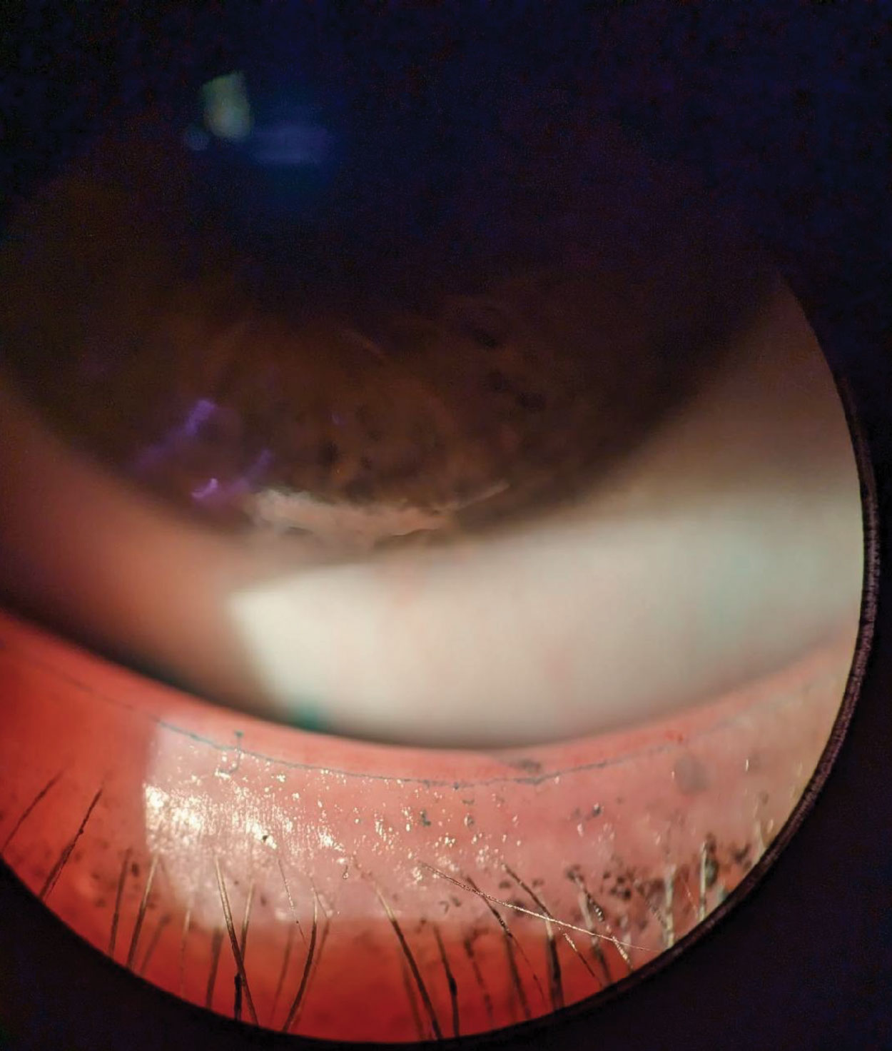 Slit lamp image of lissamine green staining of Marx’s Line on the lower lid, marking the mucocutaneous junction of the eyelid.