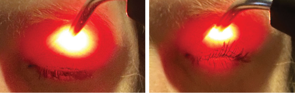 Korb-Blackie lid test to monitor for incomplete lid seal. Left image demonstrates artificially induced positive finding (visible light between lashes) when excessive pressure is applied to lid. Right image demonstrates proper testing procedure with no visible light between lashes.