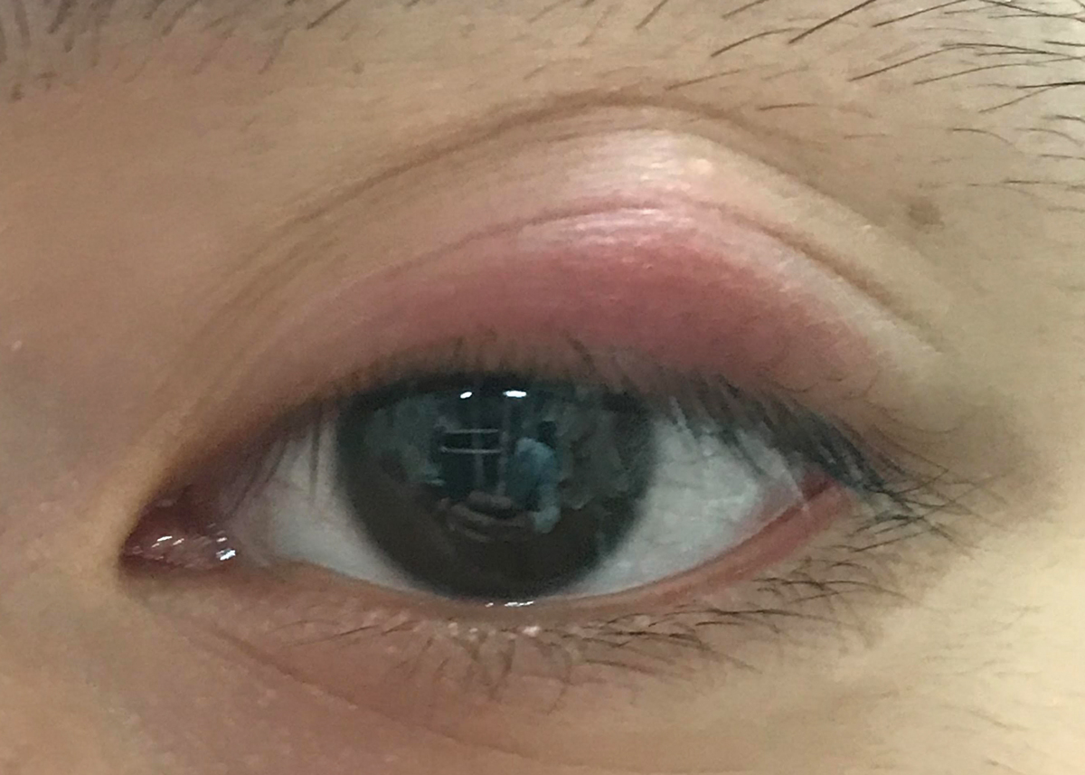 Fig. 1. Chalazion of the left upper lid that has been present for one month.