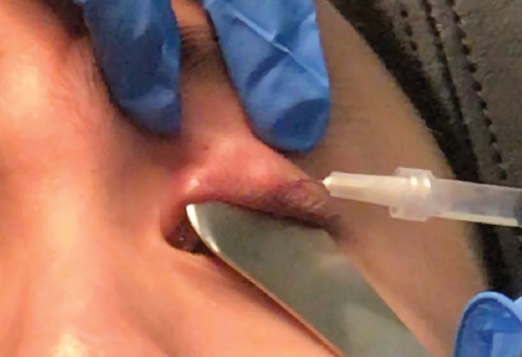 Fig. 2. Injection of triamcinolone acetonide into and around the chalazion showing proper angle of the needle.