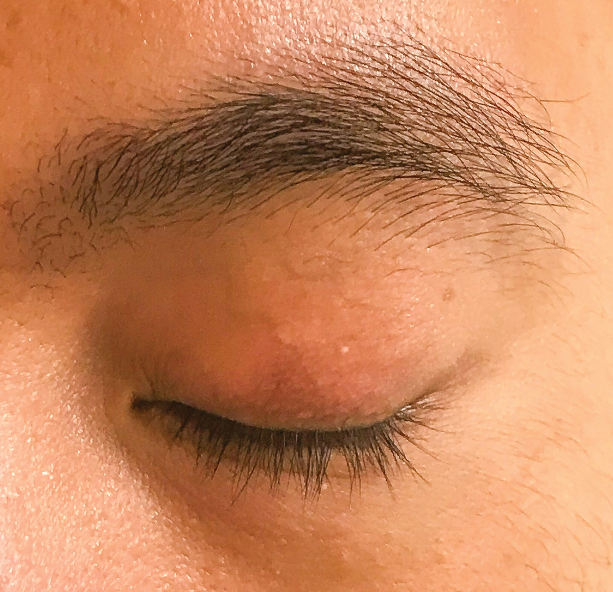 Fig. 5. Resolution of the chalazion four to five weeks post-injection.