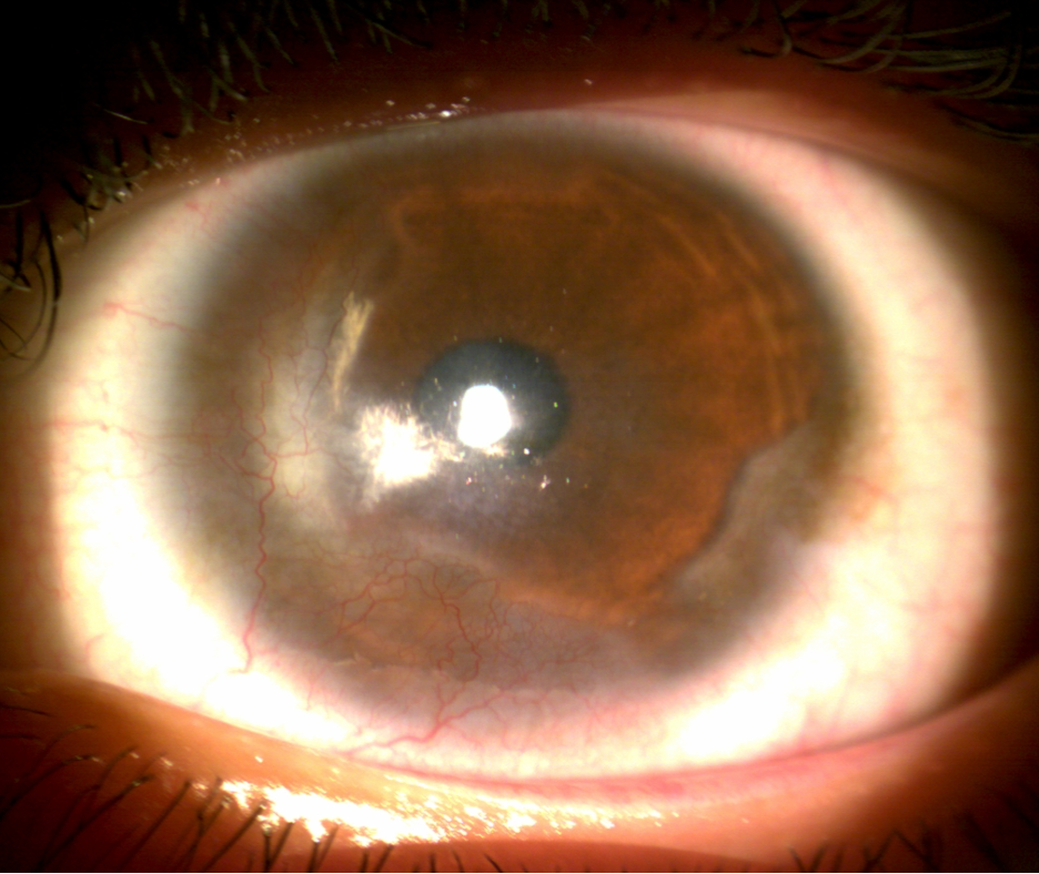 Fig. 1. Limbal stem cell deficiency can develop from DED-related chronic inflammation to the limbus.