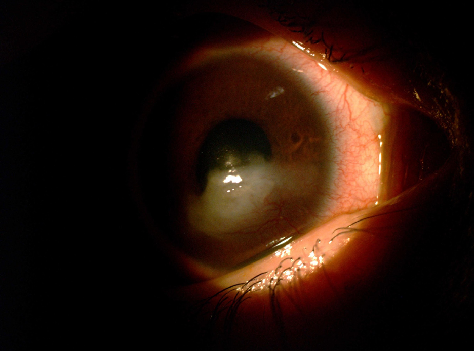 Fig. 2. Exposure keratitis can cause severe dryness and desiccation in the cornea, causing scarring. 