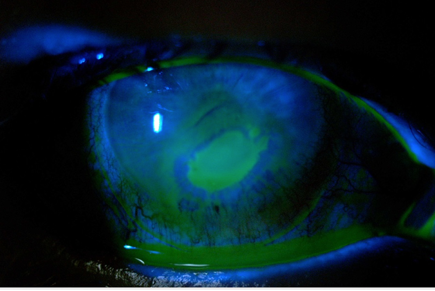 Fig. 3. Persistent epithelial defects can occur from loss of corneal innervation from dry eye.