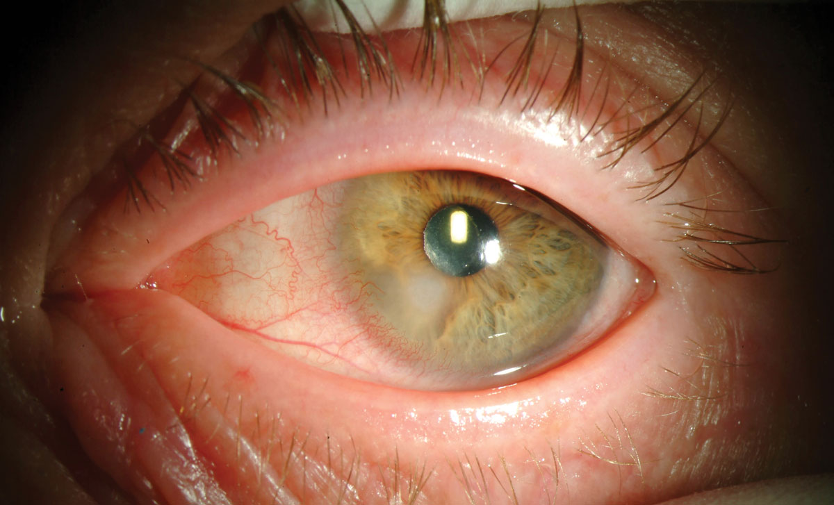 An example of Pseudomonas microbial keratitis infection, a class of infection which can be exacerbated by contact lens non-adherence.