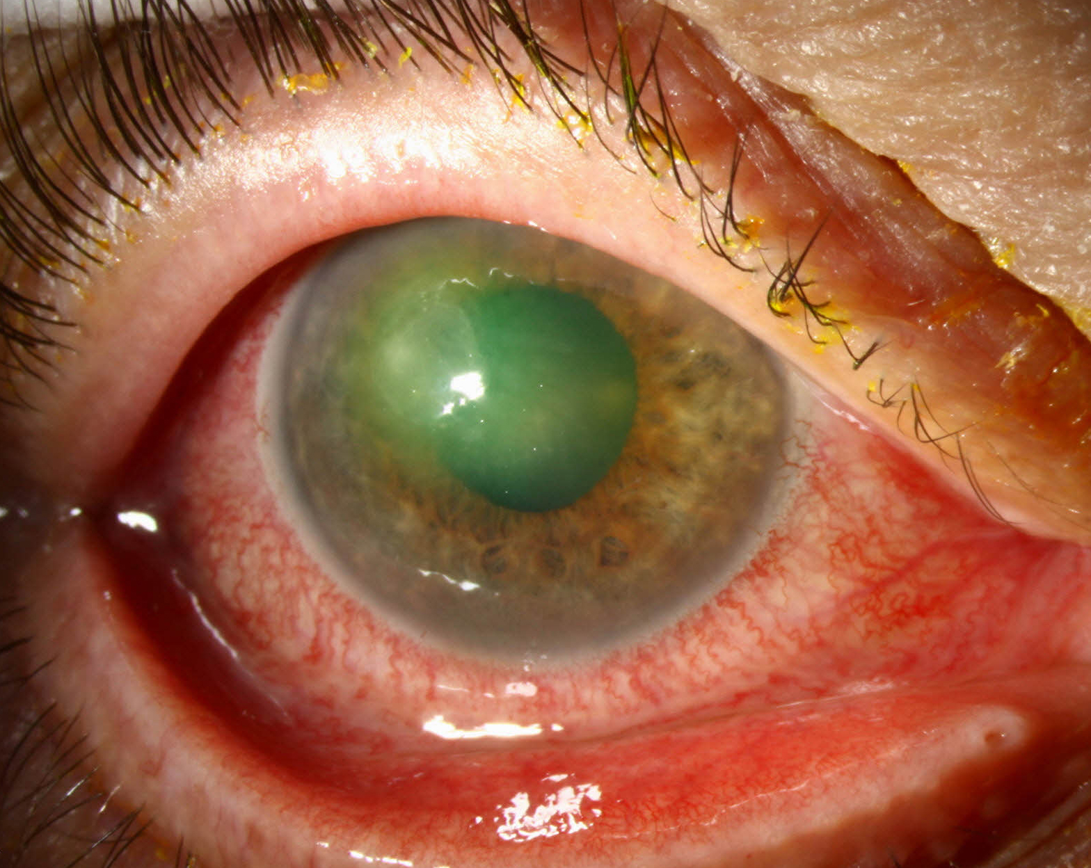 Findings suggest that where a patient with microbial keratitis lives was associated with VA at presentation.
