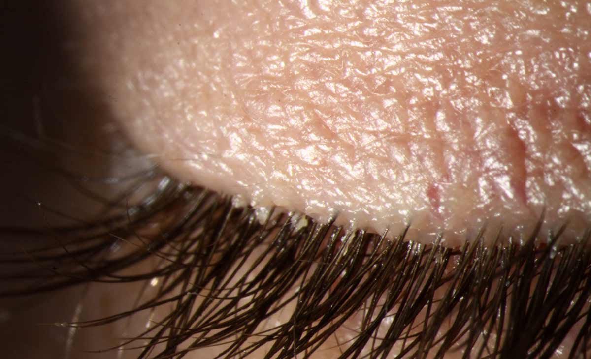 Increased Demodex mite colonization was found in the eyelids of patients who had recently undergone cataract surgery. Researchers suggest that adjusting the postoperative topical steroid dose may help to reduce the risk.