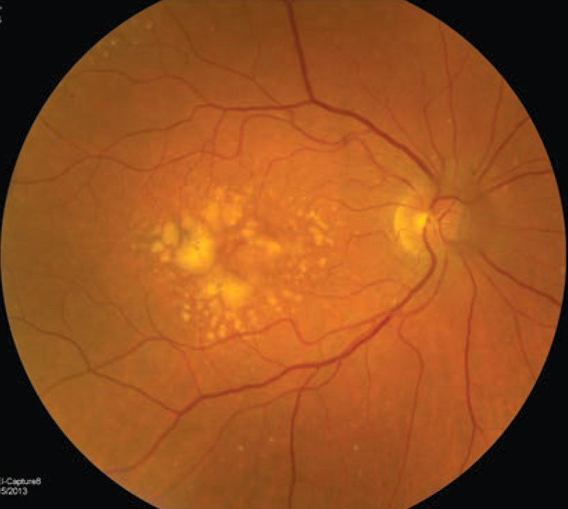 In a small cohort, patients with drusenoid or serous PEDs had a dramatic reduction in vision as the PED was reabsorbed. An area of GA also occurred where the PED had previously been.