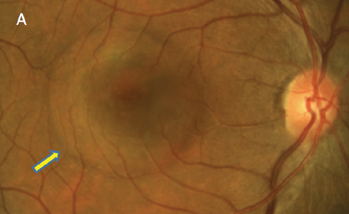 The reduction in parafoveal GCC and foveal outer nuclear layer thicknesses in patients with central serous chorioretinopathy, in the absence of subretinal fluid, was found with OCT.