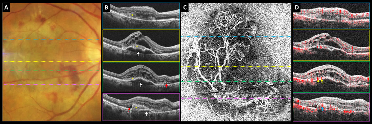 In type 2 macular neovascularization cases like this one, decreased retinal sensitivity likely results from new vessel growth between the neurosensory retina and RPE, study finds. White arrows point to PED, yellow asterisk shows subretinal neovascular membrane, red arrows highlight subretinal fluid, yellow arrows indicate subretinal feeder vessels and blue arrow points to subretinal neovascular membrane.
