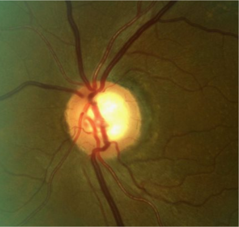 Study shows placebo can have a true clinical effect in ocular hypotensive therapy.